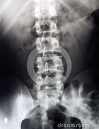 Lumbar spine x-ray, lower back