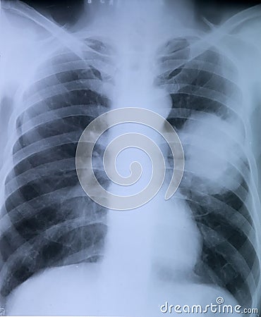 Lung cancer:X-ray image of chest