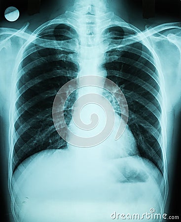 Lungs X-Ray