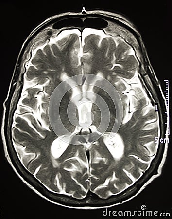 Magnetic Resonance Of Brain, MR