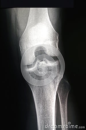 Male Right Knee - Bent