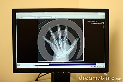 Modern x-ray display of human hand