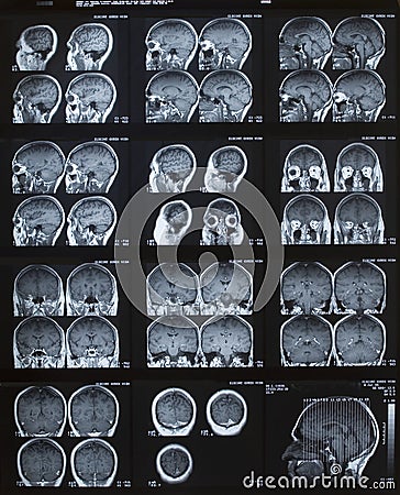 MRI Brain
