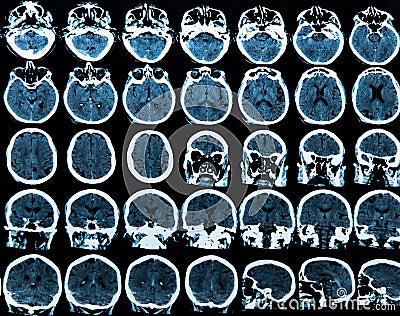 Mri Brain Scan