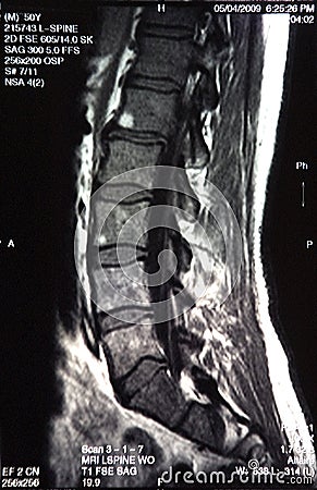 MRI CAT Scan Spine Detail Xray