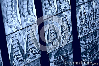 MRI image of human spine