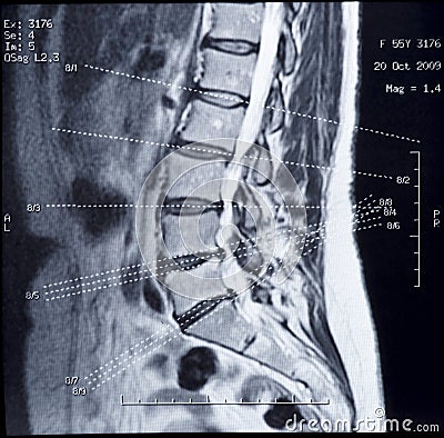 MRI image of human spine