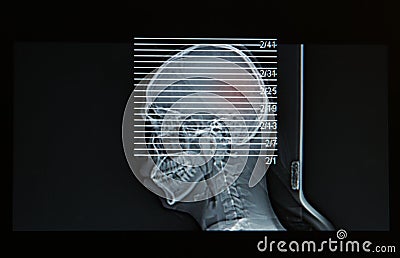 MRI Scan of head of human show head injury
