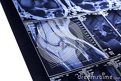 My knee MRI - damage of cross-shaped ligaments