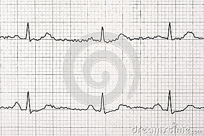 Normal Electrocardiogram Record Macro