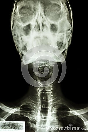 Normal human s skull and cervical spine