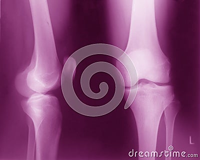 Normal Knee x ray
