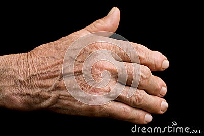 Old hand with arthritis