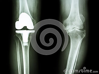 Osteoarthritis knee patient and artificial joint