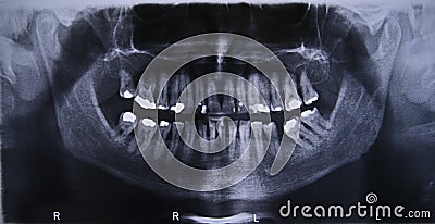 Panoramic dental x-ray