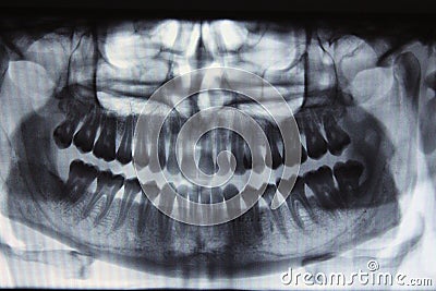 Panoramic dental X-ray - one wisdom teeth missing