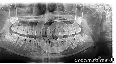 Panoramic dental X-Ray before orthodontic treatment with bud of wisdom teeth