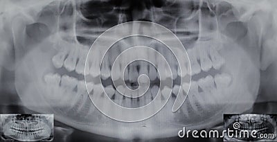 Panoramic dental X-ray - 32 teeth - 4 wisdom