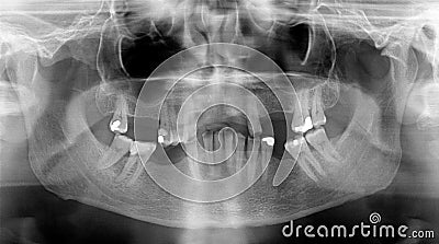 Panoramic dental X-Rays