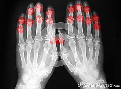 Plain film, radiography, of both hands, arthritis