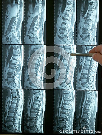 Pointing to an mri of lumbar spine