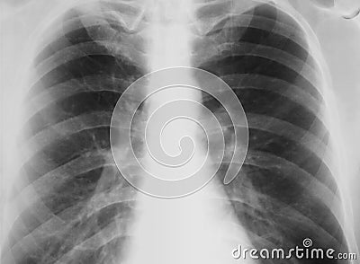Real-world chest X-ray with symptom of chronic bro