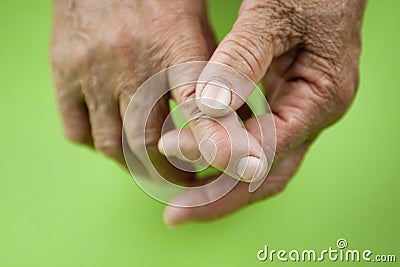 Rheumatoid arthritis hands