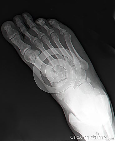 Right foot x-ray#2