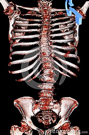 Scoliosis. Osteoporosis. CT-scan reconstruction