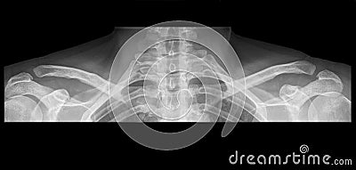 Shoulder X-ray