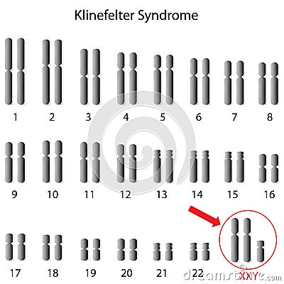 sindrome-di-klinefelter-26951617