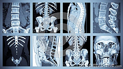 Skeletal Computer Tomography Scan