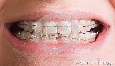 Smile with braces