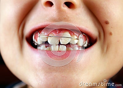 Smile with braces on teeth