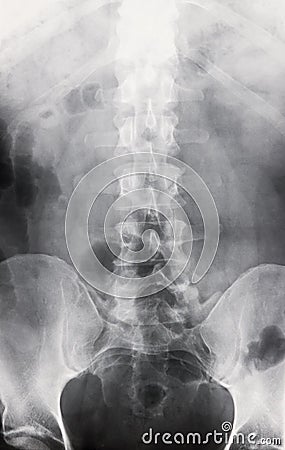 Spine X-ray and Iliac Crests