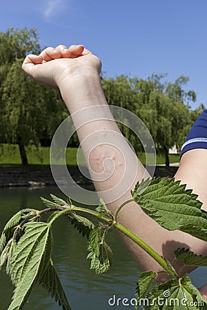 Stinging nettle allergic reaction