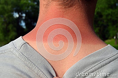 Sunburnet skin