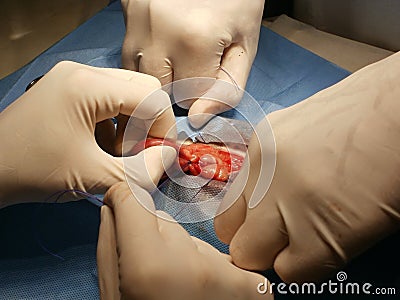 Surgical removal of ovaries