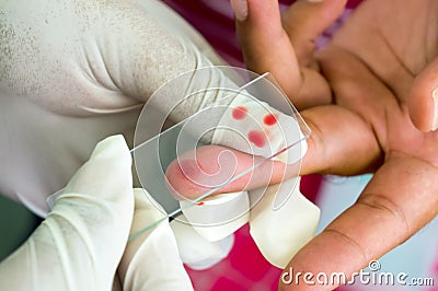 Taken blood films for Malaria