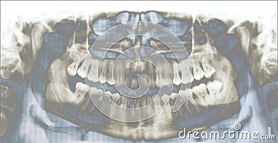 Teeth X-ray