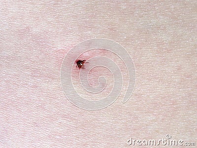 Tick, Insect, Bug Bite, Parasite