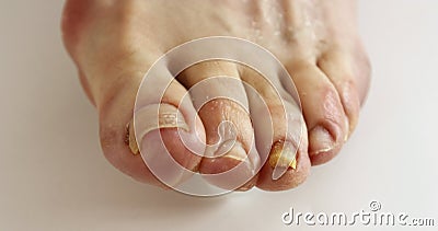 Toenail Fungus