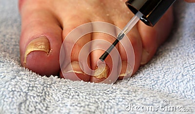 Toenail Fungus Treatment