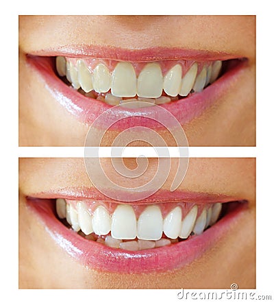 Tooth whitening - before ,after