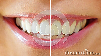 Tooth whitening - before ,after