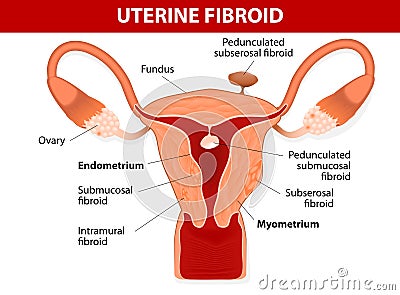 Uterus & types of fibroids