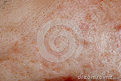Whelk skin texture