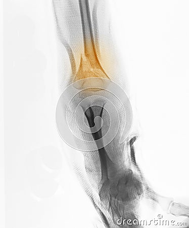 X-ray, 4 year old boy, fracture of distal humerus