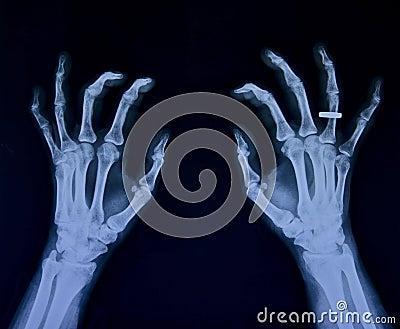 X ray of both hands, female