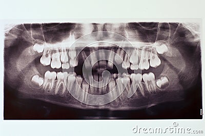 X-ray of boy s teeth